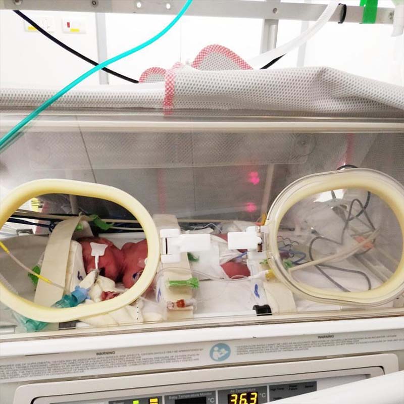 Baby Elsie hooked up to an incubator shortly after her birth. Shows the health effects of prematurity on a baby.